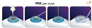 (PRK)عمل پی آر کی چشم