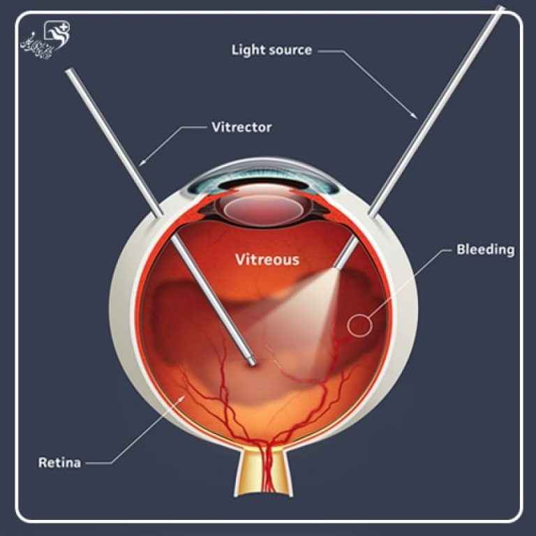 عمل ویترکتومی چشم