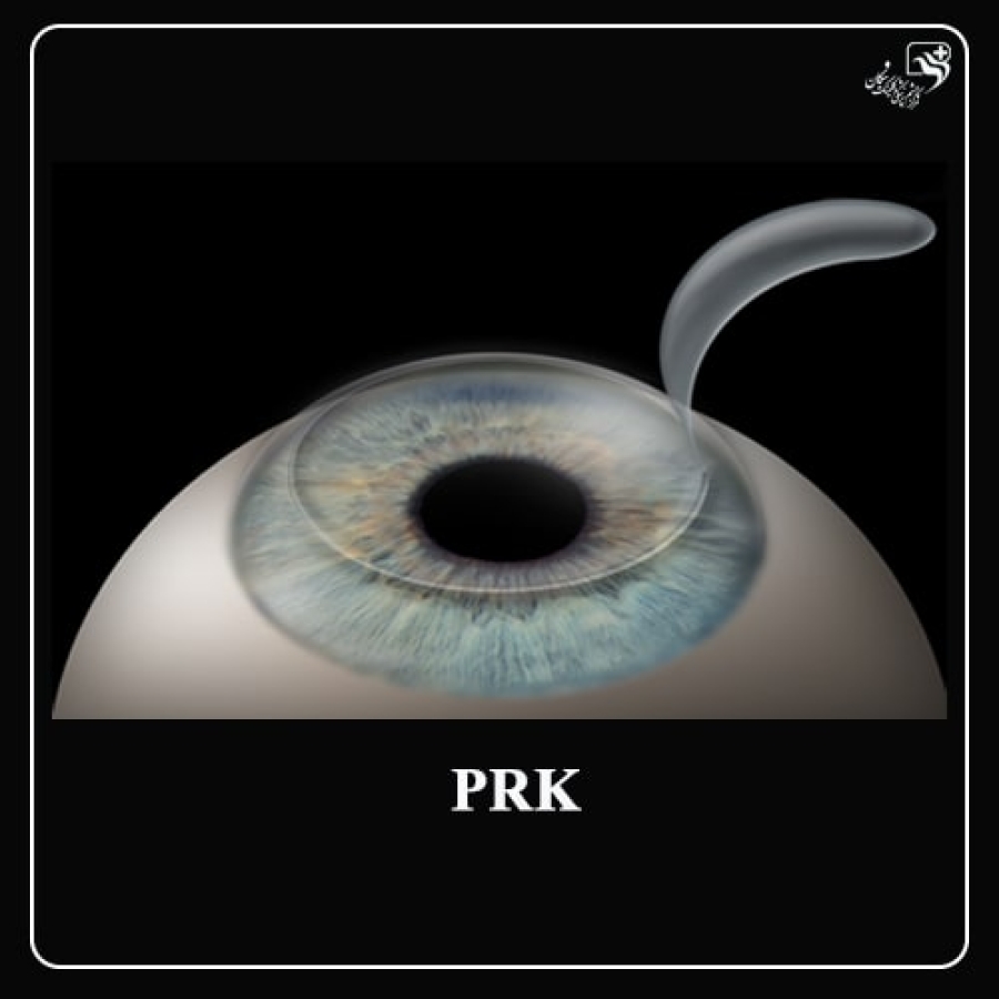 (PRK)عمل پی آر کی چشم