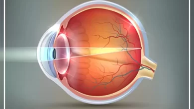 اصلاح عیوب انکساری