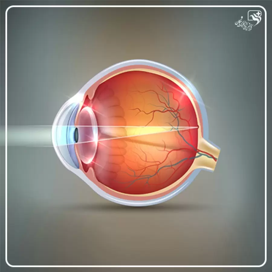 اصلاح عیوب انکساری