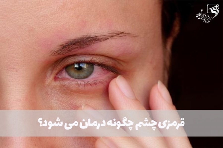 قرمزی چشم چگونه درمان می شود؟